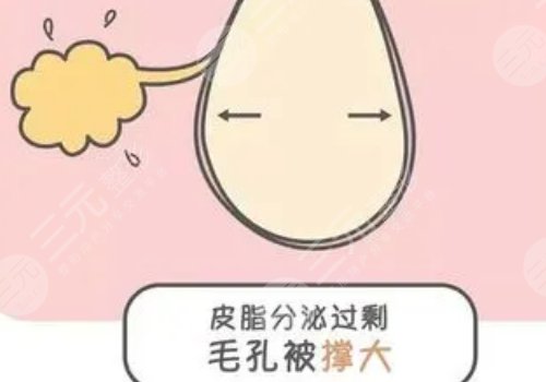 男性毛孔粗大油膩怎么改良？