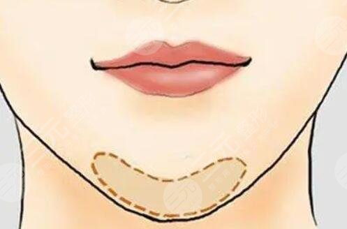 玻尿酸豐下巴會(huì)變形嗎？塑形效果理想嗎？注意事項(xiàng)都有哪些？