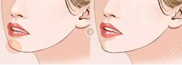 玻尿酸豐下巴會(huì)變形嗎?