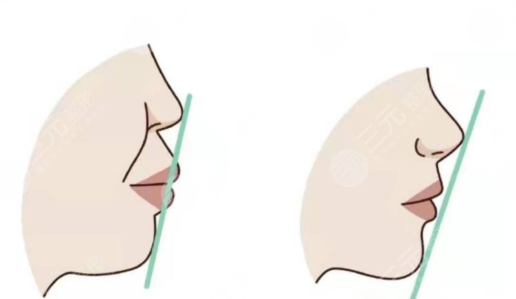 玻尿酸豐下巴的注意事項(xiàng)