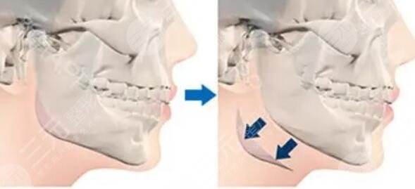 磨下頜骨瘦臉有后遺癥嗎怎么緩解？可能伴隨的風(fēng)險(xiǎn)！