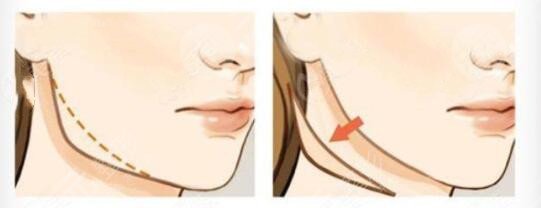 磨下頜骨瘦臉有后遺癥嗎怎么緩解？可能伴隨的風(fēng)險(xiǎn)！