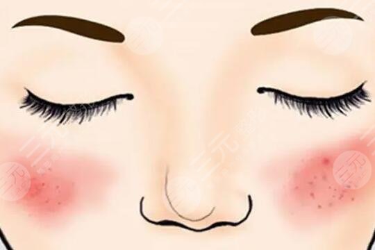 彩光祛紅血絲的危害有哪些？它的原理是什么？注意事項(xiàng)有哪些？