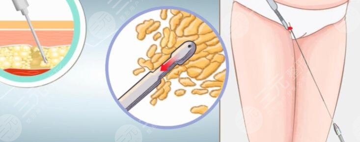 吸脂減肥會(huì)反彈嗎？該怎么做預(yù)防術(shù)后反彈？要做好這2點(diǎn)~