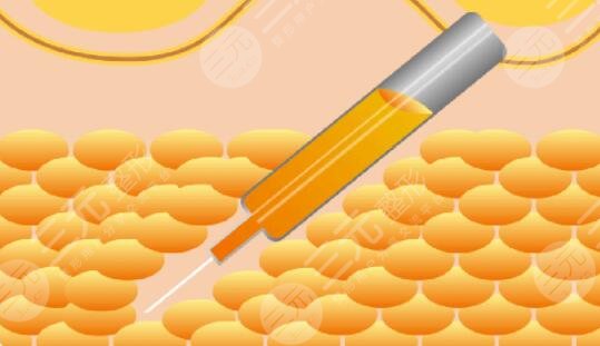 吸脂減肥會(huì)反彈嗎?