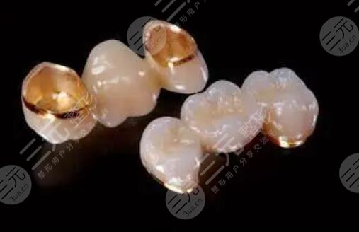 全瓷牙價(jià)格影響的因素