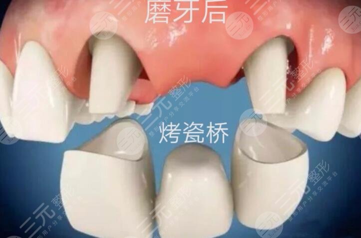 全瓷牙價(jià)格影響的因素