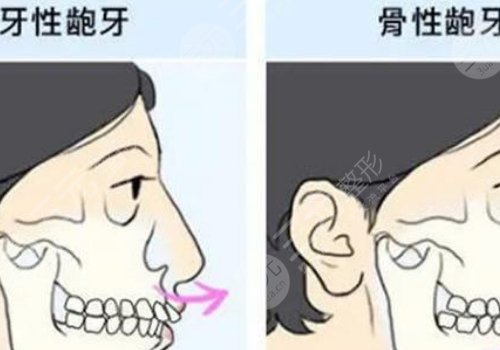 嘴凸怎么辦？