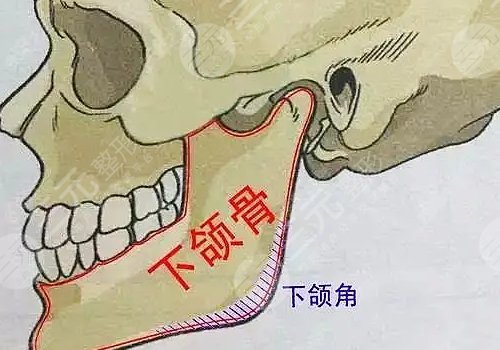 下頜角寬大怎么改良？