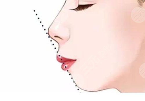 嘴凸是怎么造成的？