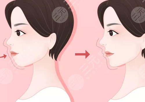 嘴凸是怎么造成的？