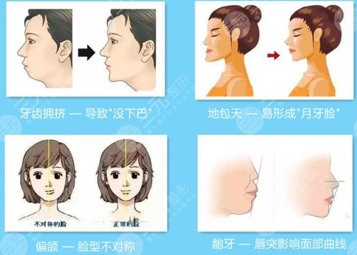 磨骨整形手術(shù)