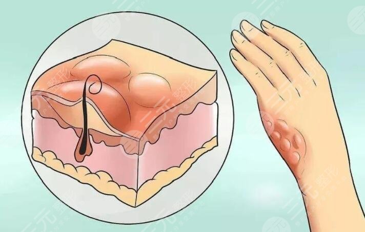 像素激光去疤痕要做多少次才會好？項目定價、注意事項有哪些？