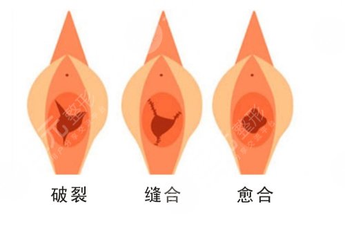 補(bǔ)處膜修復(fù)后會(huì)出血嗎？