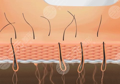 脫毛儀哪個(gè)牌子效果比較好？