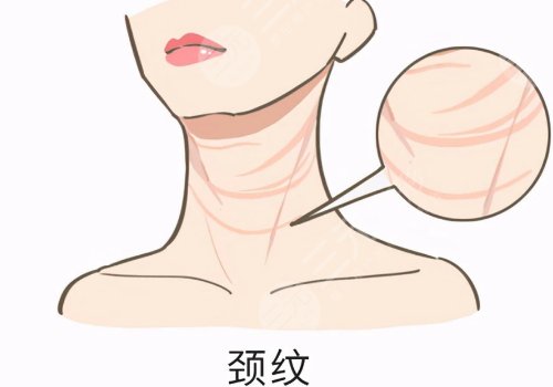頸紋特別深怎么去除？