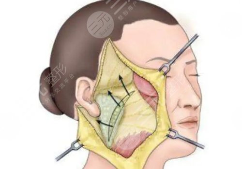 拉皮手術(shù)多大年齡做合適？