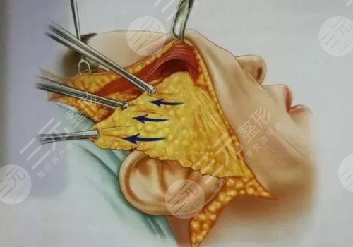 拉皮手術(shù)多大年齡做合適？