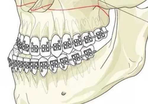星港華高偉正頜怎么樣?