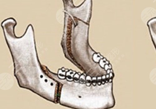 星港華高偉正頜怎么樣?