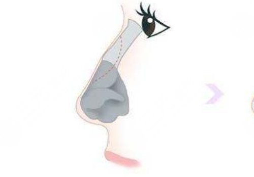 肋骨隆鼻肋骨取了對(duì)身體有影響嗎？