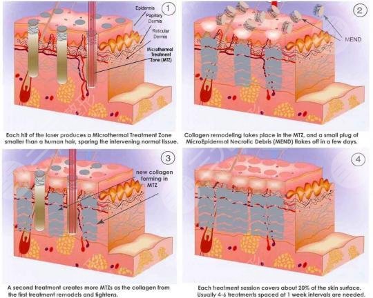 像素射頻儀器祛疤有用嗎？