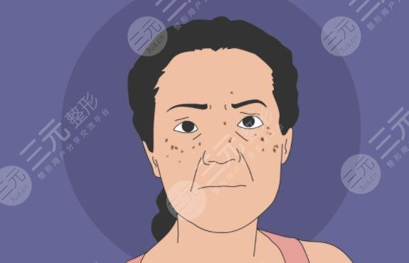 為什么會(huì)長(zhǎng)有老年斑?