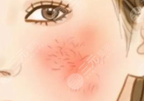 臉上長紅血絲怎么去掉？