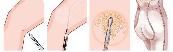 腿部吸脂手術(shù)多少錢一次啊？腿部吸脂手術(shù)潛在的危害有哪些？