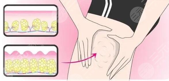 腿部吸脂手術(shù)多少錢一次啊?