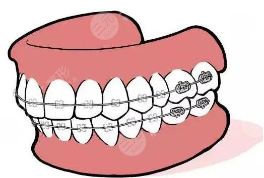 22歲還能矯正牙齒么？需要戴牙套多長時間？大概多少錢？