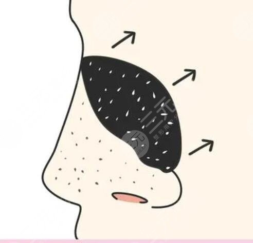 如何收縮鼻頭毛孔粗大小妙招，告別鼻頭黑點(diǎn)點(diǎn)！