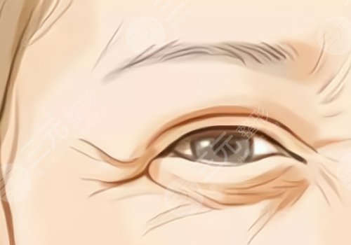 魚尾紋怎么才能去掉？