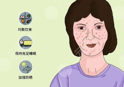 怎樣去除面部黃褐斑有效？