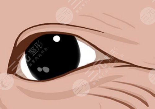 怎么樣去除眼部皺紋？