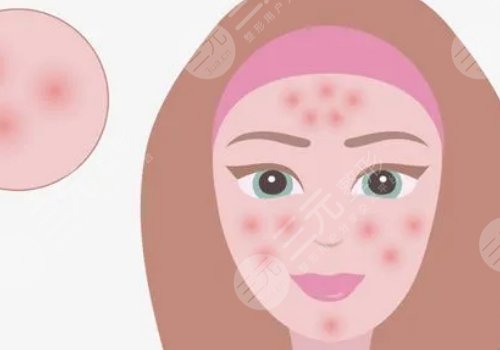 臉上有痘印怎么辦才能去掉呢？