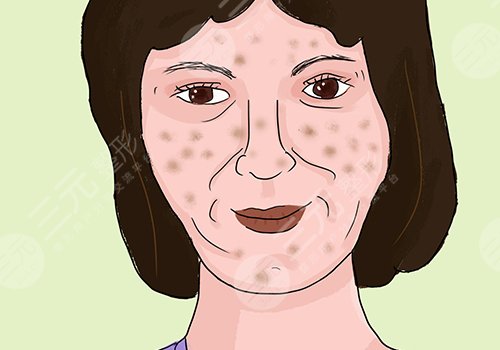 臉上的色斑怎么去掉(淡化)？