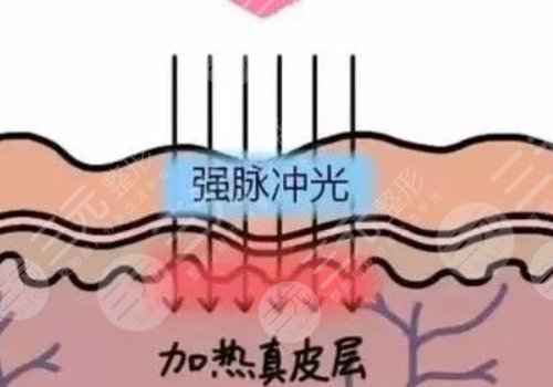 彩光嫩膚和光子嫩膚有什么區(qū)別？