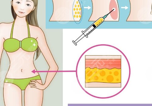 腹部抽脂術(shù)后需要修復(fù)多久？