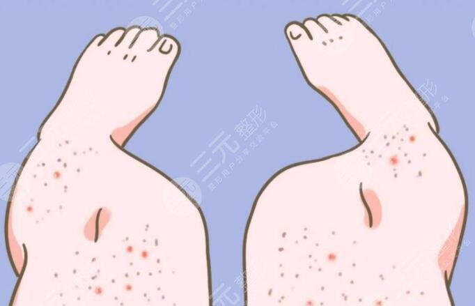 雞皮疙瘩皮膚怎么治比較好？雞皮疙瘩皮膚形成原因及日常護(hù)理