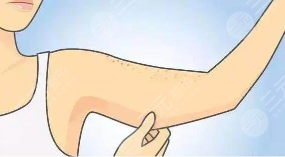 雞皮疙瘩皮膚怎么治比較好?