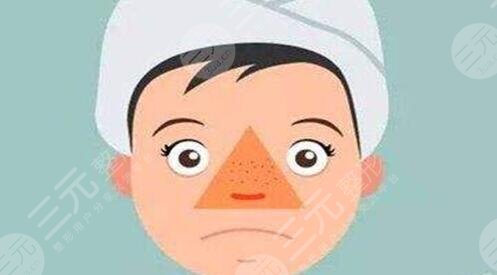 激光緩解鼻子痤瘡效果如何?