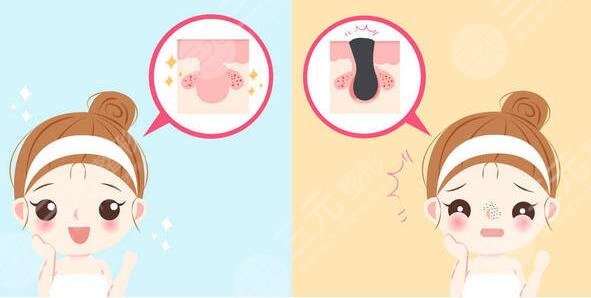 激光緩解鼻子痤瘡注意事項(xiàng)有哪些?