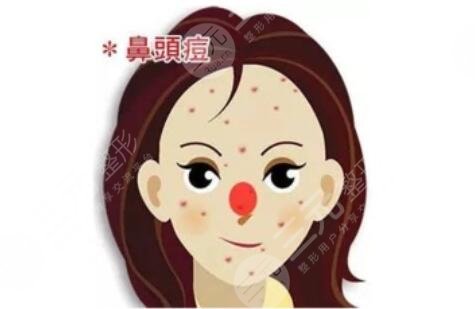 激光緩解鼻子痤瘡注意事項(xiàng)有哪些?