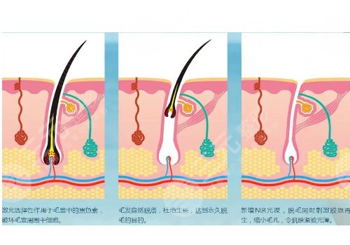 男士激光脫毛效果如何？
