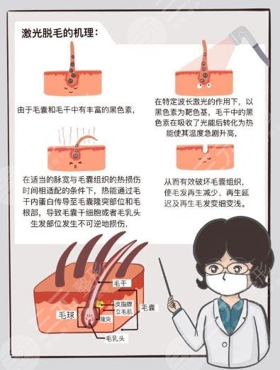 男士激光脫毛效果如何？