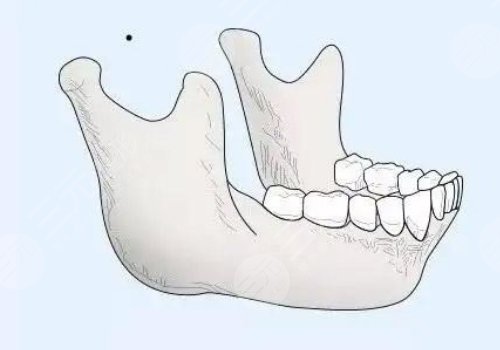 下頜角寬大怎么改良？