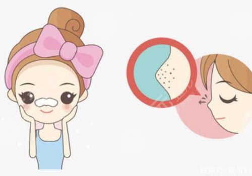 黑頭怎么去除有效？