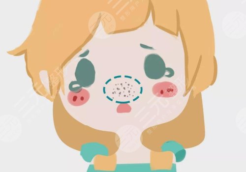 黑頭怎么去除有效？