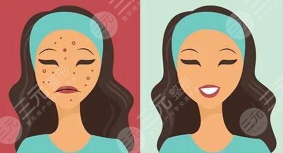 光子嫩膚去除紅色痘印需要多少錢?